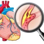 Óleos Essenciais para Arteriosclerose