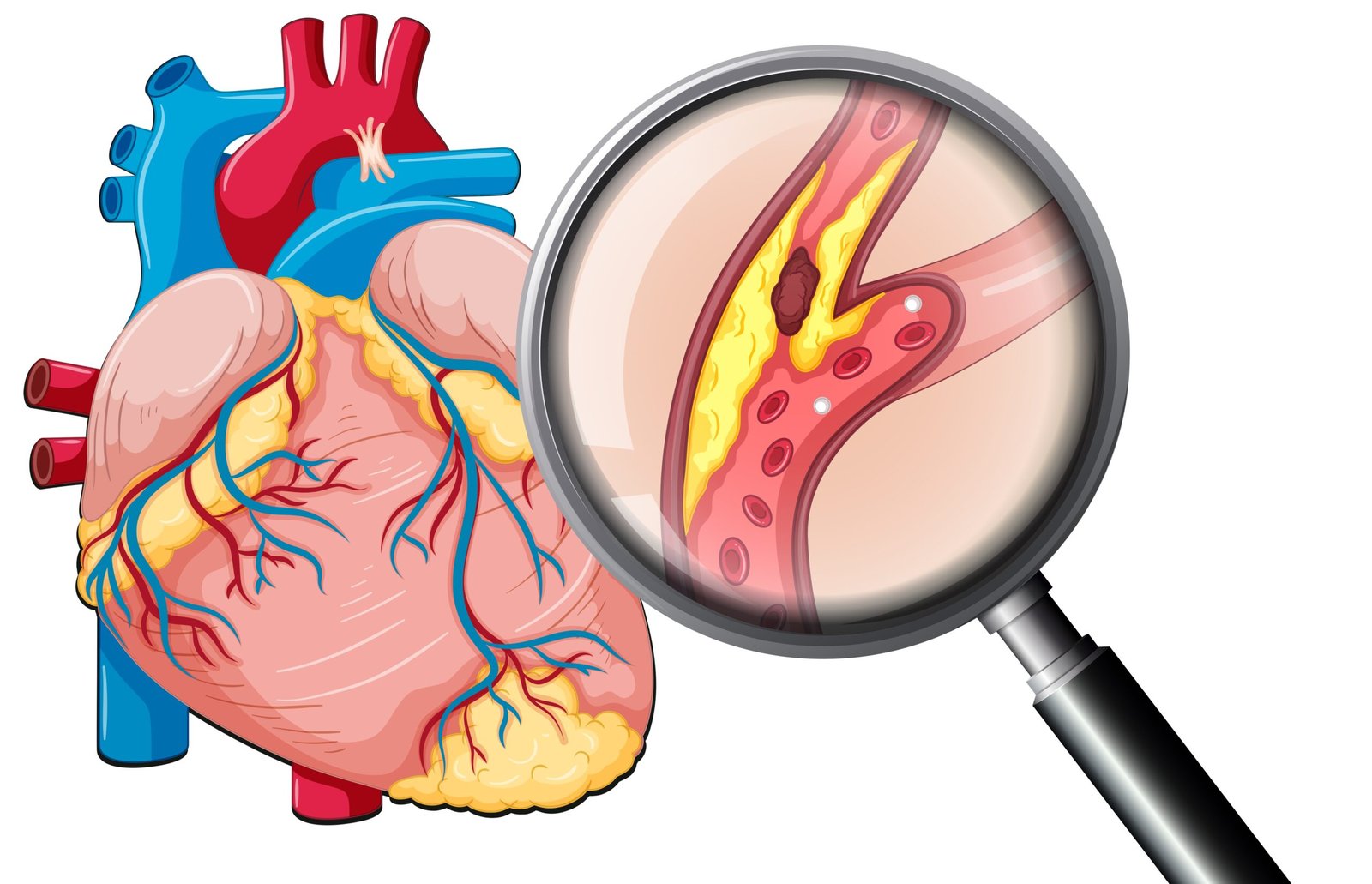 Óleos Essenciais para Arteriosclerose