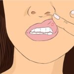 Óleos Essenciais para Afta