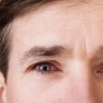 Óleos Essenciais para Conjuntivite