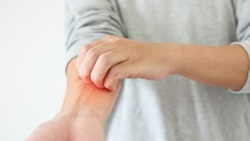 Óleos Essenciais para Eczema
