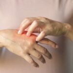 Óleos Essenciais para Queimaduras