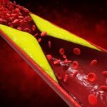 Óleos Essenciais para Aterosclerose