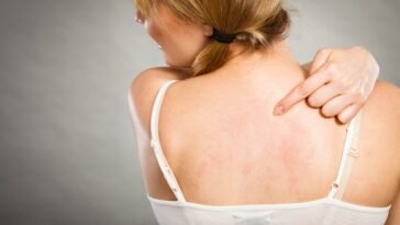 Óleos Essenciais para Irritação na Pele