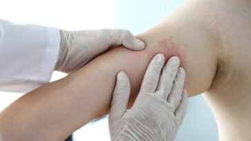Óleos Essenciais para Cobreiro - herpes zóster