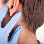 Óleos Essenciais para Verrugas