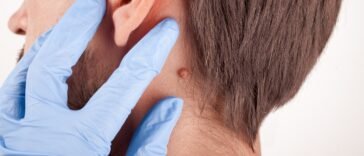 Óleos Essenciais para Verrugas