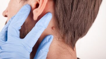 Óleos Essenciais para Verrugas