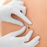 Óleos Essenciais para Melanoma