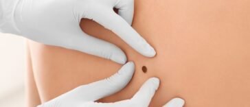 Óleos Essenciais para Melanoma