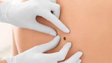 Óleos Essenciais para Melanoma